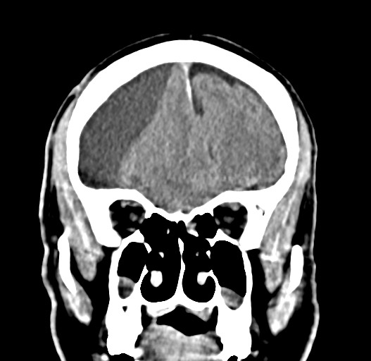 Acute on chronic subdural hematoma (Radiopaedia 78346-90966 Coronal non-contrast 20).jpg
