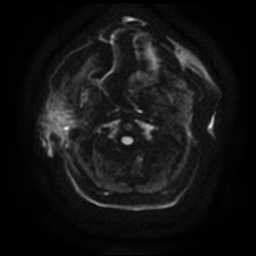 Acute otitis externa (Radiopaedia 57296-64236 Axial DWI 12).jpg
