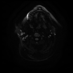 Acute otitis externa (Radiopaedia 57296-64236 Axial DWI 16).jpg