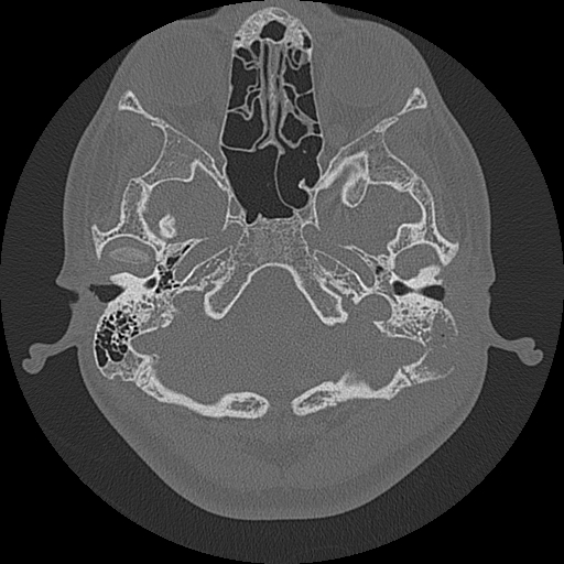 Acute otomastoiditis and Bezold abscess (Radiopaedia 88184-104786 Axial bone window 26).jpg
