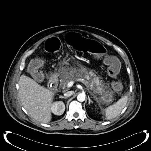 Acute pancreatic necrosis (Radiopaedia 13560-18500 Axial C+ portal venous phase 52).jpg