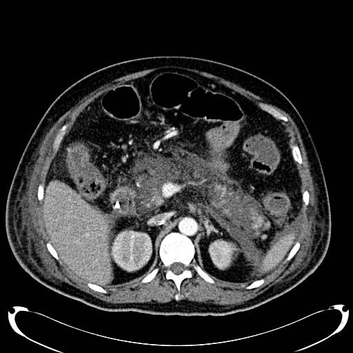 Acute pancreatic necrosis (Radiopaedia 13560-18500 Axial C+ portal venous phase 55).jpg