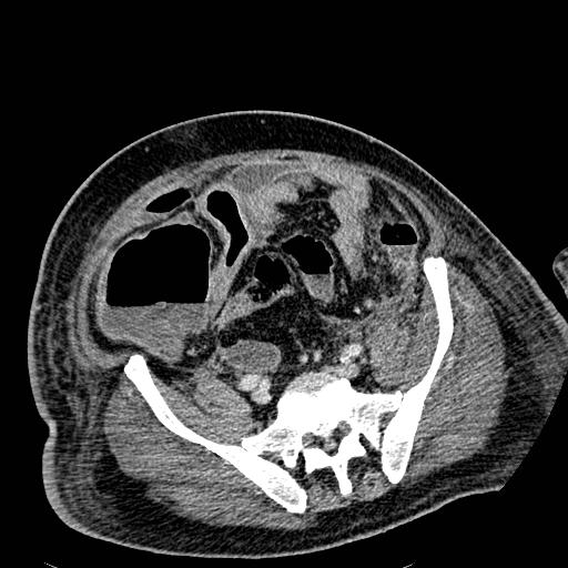 Acute pancreatic necrosis (Radiopaedia 13560-18501 Axial C+ portal venous phase 109).jpg
