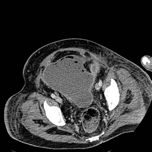 File:Acute pancreatic necrosis (Radiopaedia 13560-18501 Axial C+ portal venous phase 130).jpg