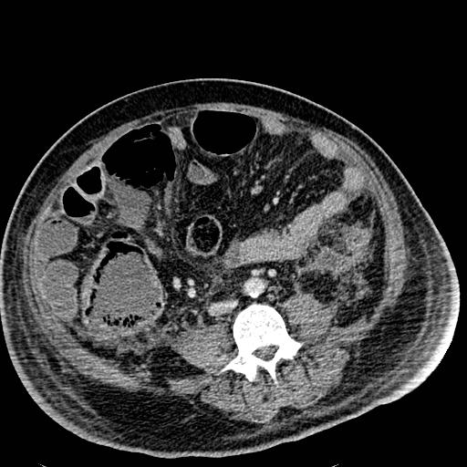 File:Acute pancreatic necrosis (Radiopaedia 13560-18501 Axial C+ portal venous phase 88).jpg