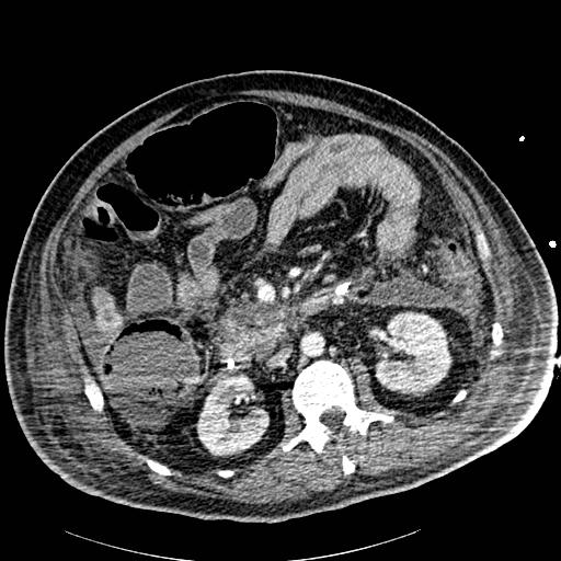 File:Acute pancreatic necrosis (Radiopaedia 13560-18502 Axial C+ portal venous phase 43).jpg