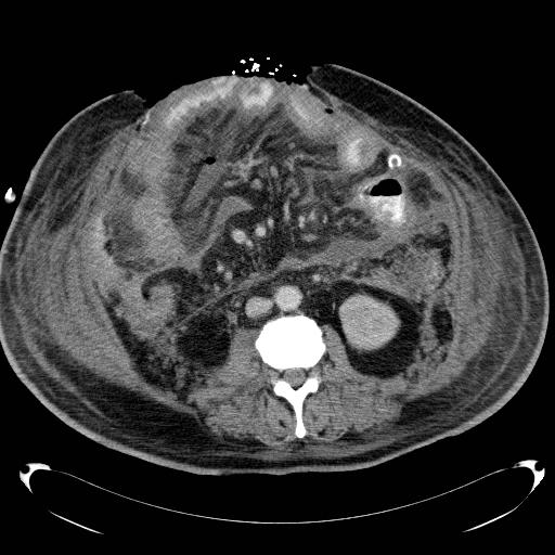 Acute pancreatic necrosis (Radiopaedia 13560-18503 Axial C+ portal venous phase 43).jpg