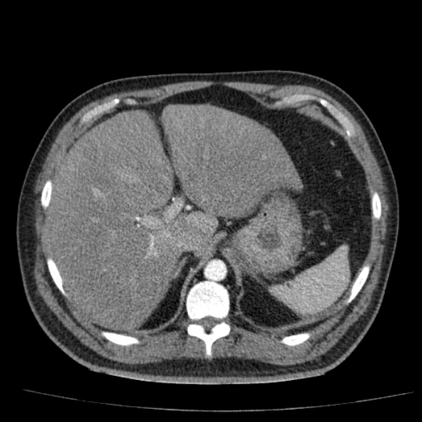 Acute pancreatitis (Radiopaedia 26663-26813 Axial C+ arterial phase 24).jpg