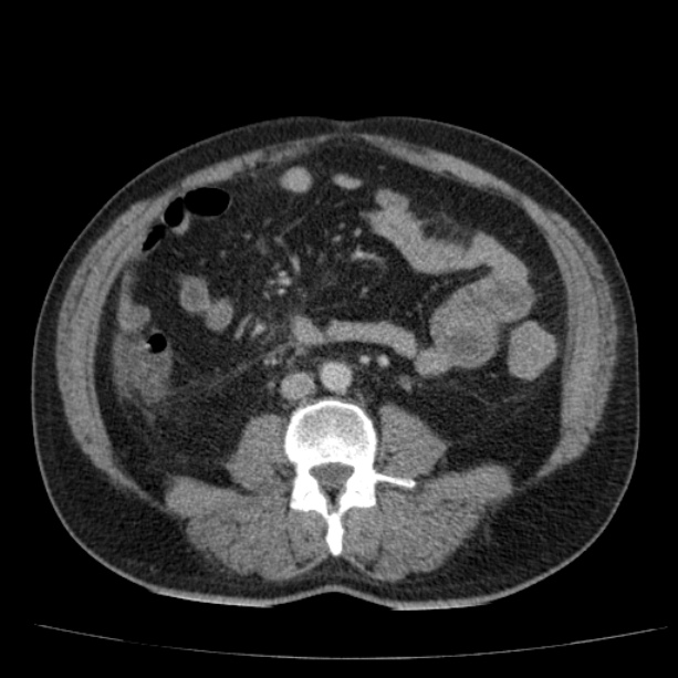 Acute pancreatitis (Radiopaedia 26663-26813 Axial C+ portal venous phase 51).jpg