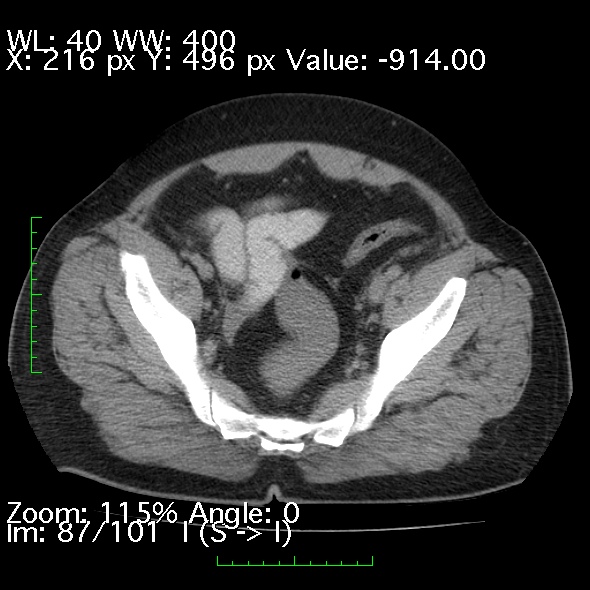 Acute pancreatitis (Radiopaedia 34043-35276 Axial non-contrast 87).jpg