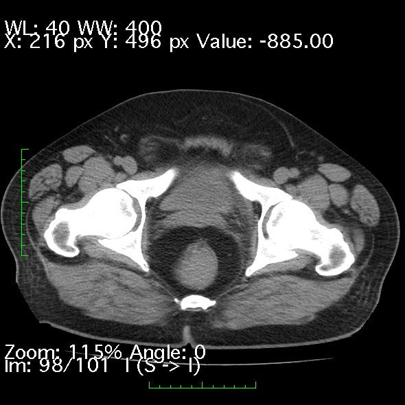 Acute pancreatitis (Radiopaedia 34043-35276 Axial non-contrast 98).jpg