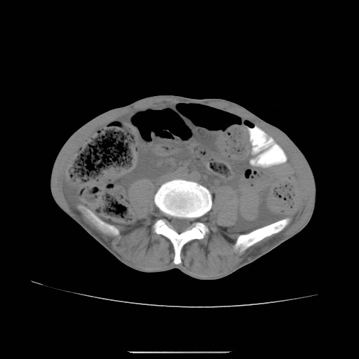 File:Acute pancreatitis (Radiopaedia 50213-55558 Axial non-contrast 30).jpg