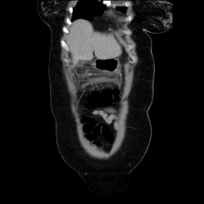Acute pancreatitis (Radiopaedia 69236-79012 Coronal C+ portal venous phase 60).jpg