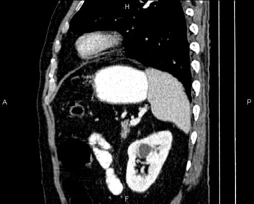 Acute pancreatitis (Radiopaedia 85146-100701 Sagittal C+ portal venous phase 73).jpg