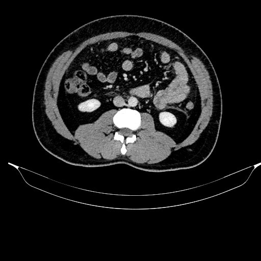 Acute pancreatitis (Radiopaedia 87428-103757 Axial C+ portal venous phase 52).jpg