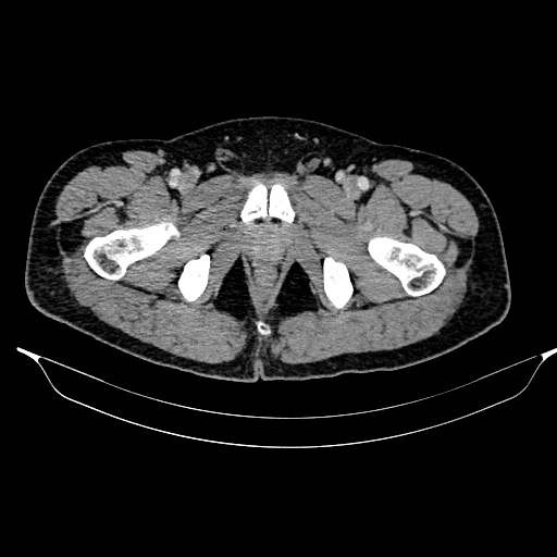 Acute pancreatitis (Radiopaedia 87428-103757 Axial C+ portal venous phase 97).jpg
