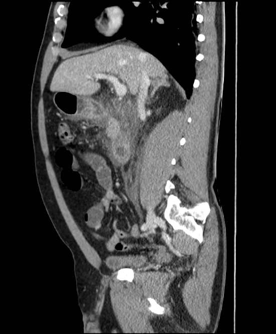 Acute pancreatitis - Balthazar E (Radiopaedia 23080-23110 Sagittal C+ portal venous phase 37).jpg