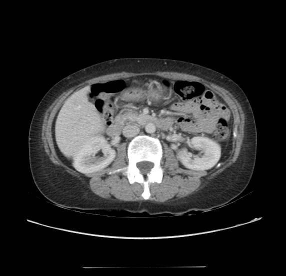 Acute pancreatitis - Balthazar E - post ERCP (Radiopaedia 27562-27772 Axial C+ portal venous phase 33).png