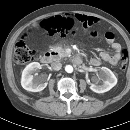File:Acute pancreatitis and walled-off necrosis (Radiopaedia 29888-30403 Axial C+ portal venous phase 23).jpg
