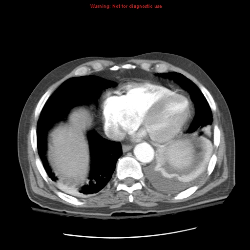 File:Acute pancreatitis with incidental pancreatic lipoma (Radiopaedia 10190-10730 Axial C+ arterial phase 10).jpg
