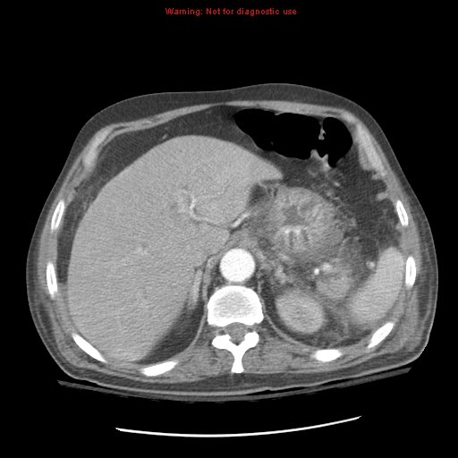 Acute pancreatitis with incidental pancreatic lipoma (Radiopaedia 10190-10730 Axial C+ arterial phase 26).jpg