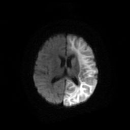 File:Acute phase of hemiconvulsion-hemiplegia epilepsy syndrome (Radiopaedia 29309-29745 Axial DWI 15).jpg