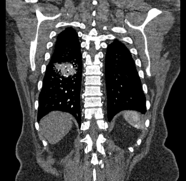 Acute pulmonary embolism with pulmonary infarcts (Radiopaedia 77688-89908 Coronal C+ CTPA 87).jpg