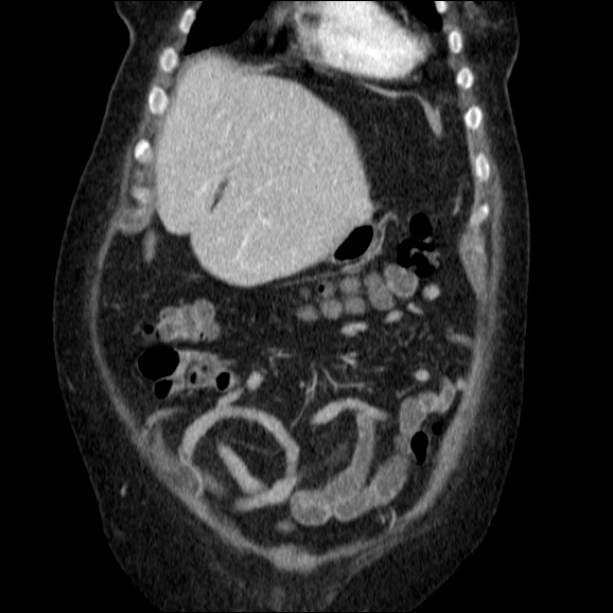 Acute pyelonephritis (Radiopaedia 26584-26729 C+ portal venous phase 19).jpg