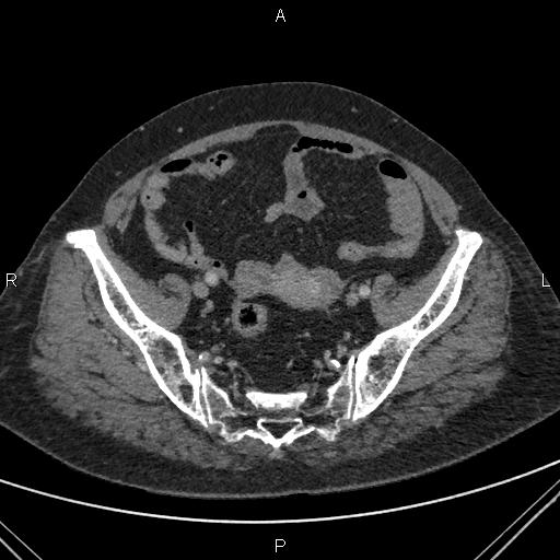 Acute renal artery occlusion (Radiopaedia 86586-102682 Axial C+ portal venous phase 79).jpg