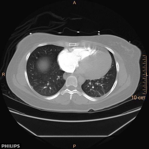 File:Acute reversible pulmonary hypertension and right heart failure from cocaine toxicity (Radiopaedia 49394-54517 Axial C+ CTPA 8).jpg