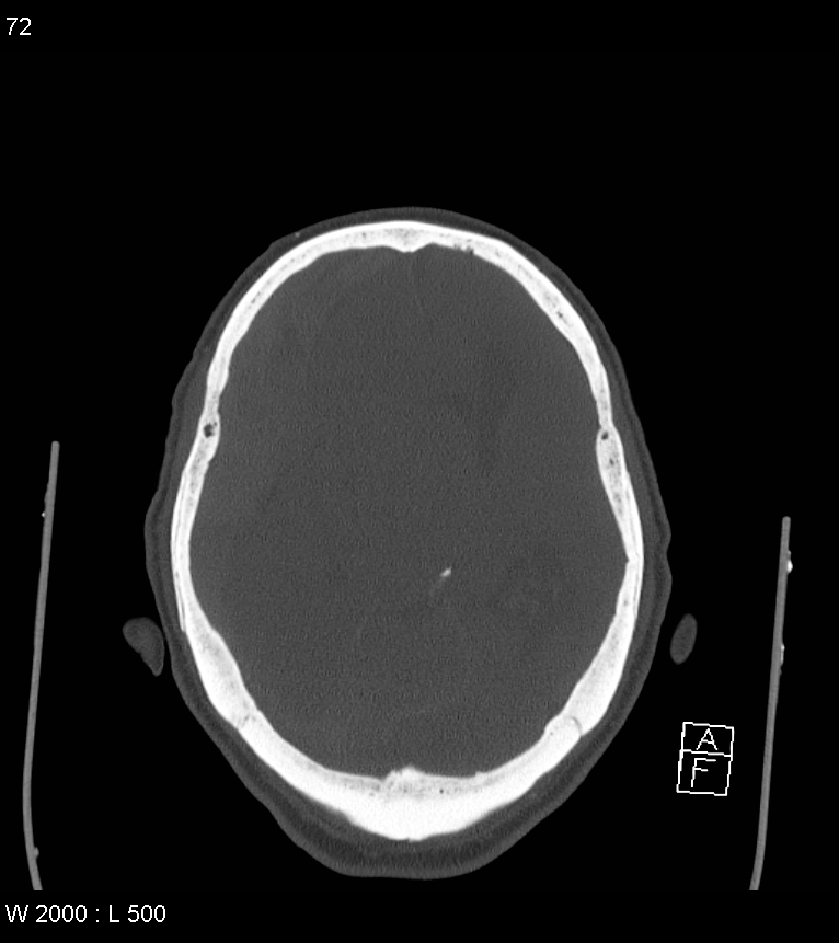 Acute subdural hematoma with myelofibrosis (Radiopaedia 52582-58494 Axial bone window 36).jpg