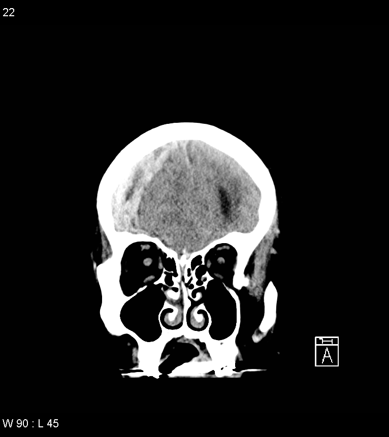 Acute subdural hematoma with myelofibrosis (Radiopaedia 52582-58494 Coronal non-contrast 13).jpg
