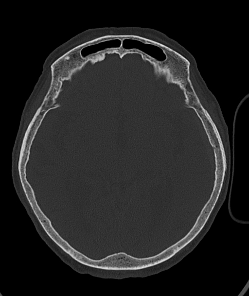 Acute traumatic subdural hematoma (Radiopaedia 82921-97257 Axial bone window 61).jpg