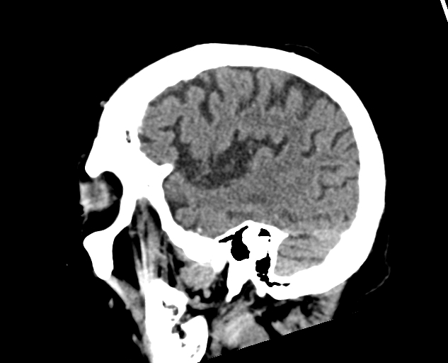 Acute traumatic subdural hematoma (Radiopaedia 82921-97257 Sagittal non-contrast 56).jpg