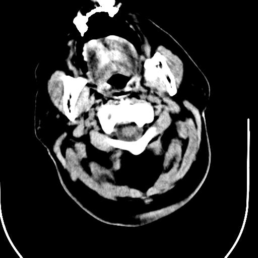 Acute vertebrobasilar ischemic infarction (Radiopaedia 25220-25473 Axial non-contrast 1).jpg