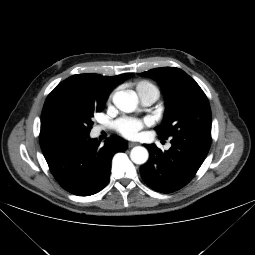 Adenocarcinoma of the lung (Radiopaedia 59871-67325 Axial C+ arterial phase 49).jpg