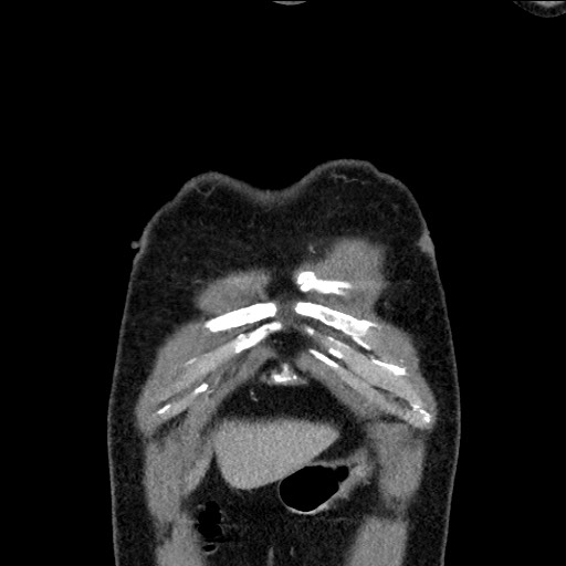 Adenocarcinoma of the lung (Radiopaedia 59871-67325 Coronal C+ arterial phase 1).jpg