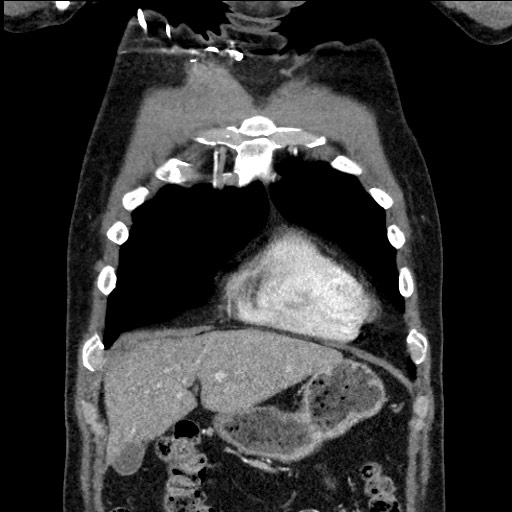 File:Adenocarcinoma of the lung (Radiopaedia 59871-67325 Coronal C+ arterial phase 11).jpg
