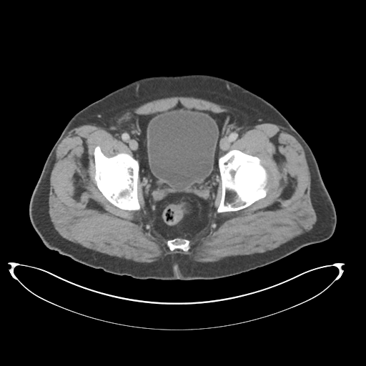 Adenocarcioma of rectum- T1 lesion (Radiopaedia 36921-38547 Axial C+ portal venous phase 81).png