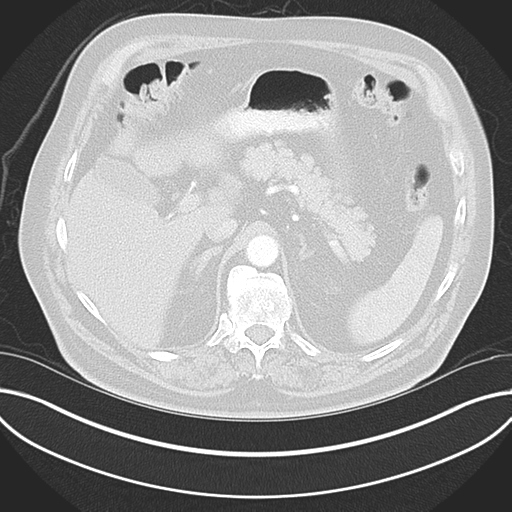 Adenocarcioma of rectum- T1 lesion (Radiopaedia 36921-38547 Axial lung window 56).png