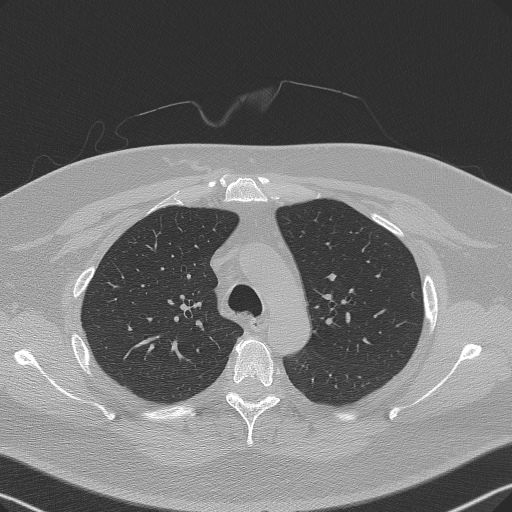 Adenoid cystic carcinoma of the trachea (Radiopaedia 49042-54137 Axial lung window 99).jpg