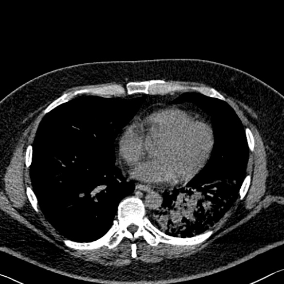 File:Adenoid cystic carcinoma of the trachea (Radiopaedia 49042-54137 Axial non-contrast 218).jpg