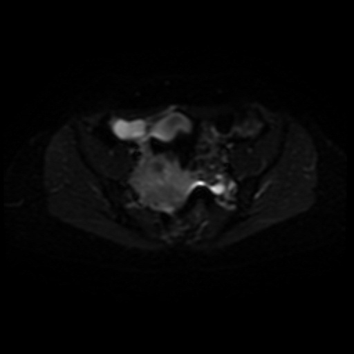 Adenoma malignum of cervix (Radiopaedia 66441-75705 Axial DWI 6).jpg