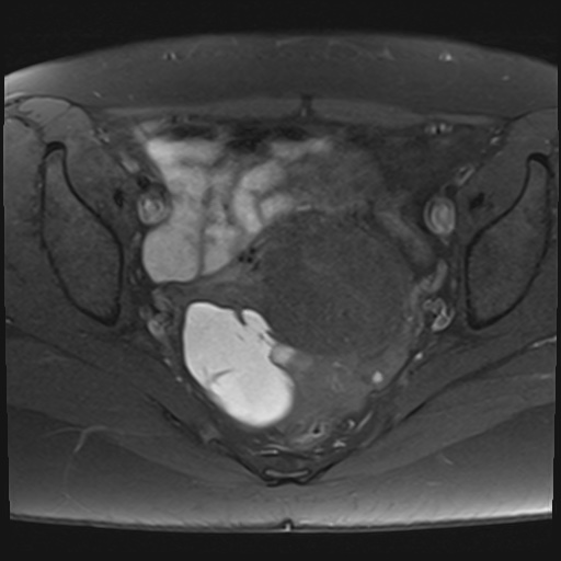 File:Adenomyosis and endometriotic cysts (Radiopaedia 82300-96367 Axial T1 fat sat 13).jpg