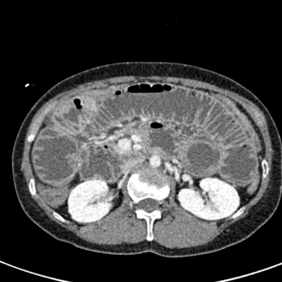Adhesional small bowel obstruction (Radiopaedia 48397-53305 Axial C+ portal venous phase 29).jpg