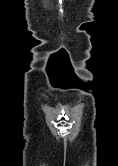 Adhesional small bowel obstruction (Radiopaedia 48397-53305 Coronal C+ portal venous phase 340).jpg