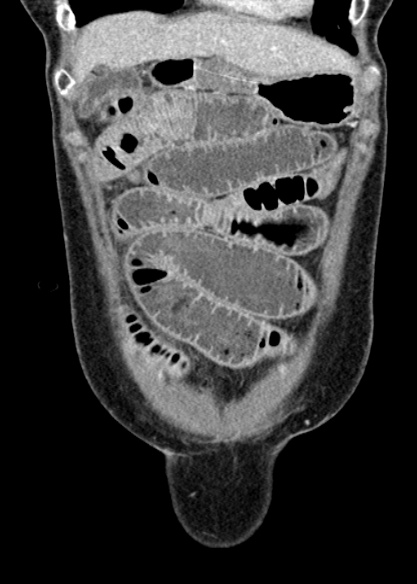 Adhesional small bowel obstruction (Radiopaedia 48397-53305 Coronal C+ portal venous phase 70).jpg