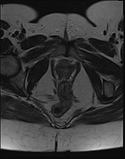 File:Adnexal multilocular cyst (O-RADS US 3- O-RADS MRI 3) (Radiopaedia 87426-103754 Axial T2 23).jpg