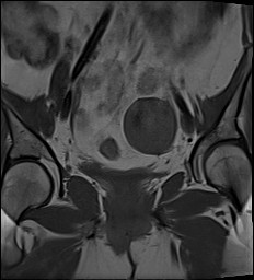 File:Adnexal multilocular cyst (O-RADS US 3- O-RADS MRI 3) (Radiopaedia 87426-103754 Coronal 15).jpg