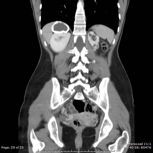 File:Adrenal calcification (Radiopaedia 55755-62314 Coronal C+ portal venous phase 29).jpg
